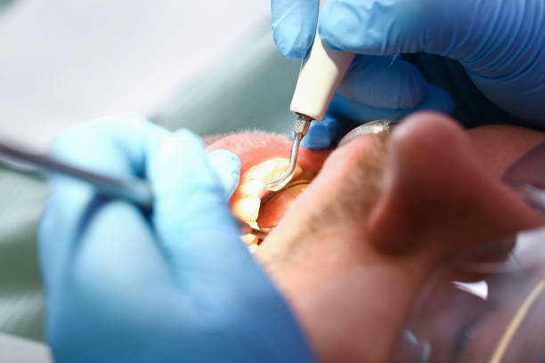 Best Emergency Dental Care for Broken or Chipped Teeth in Drew, MS